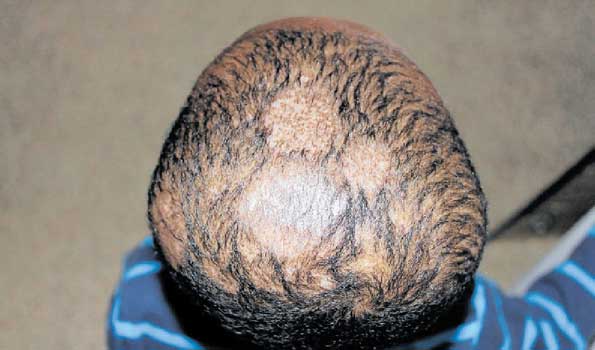what to do for ringworm on scalp
