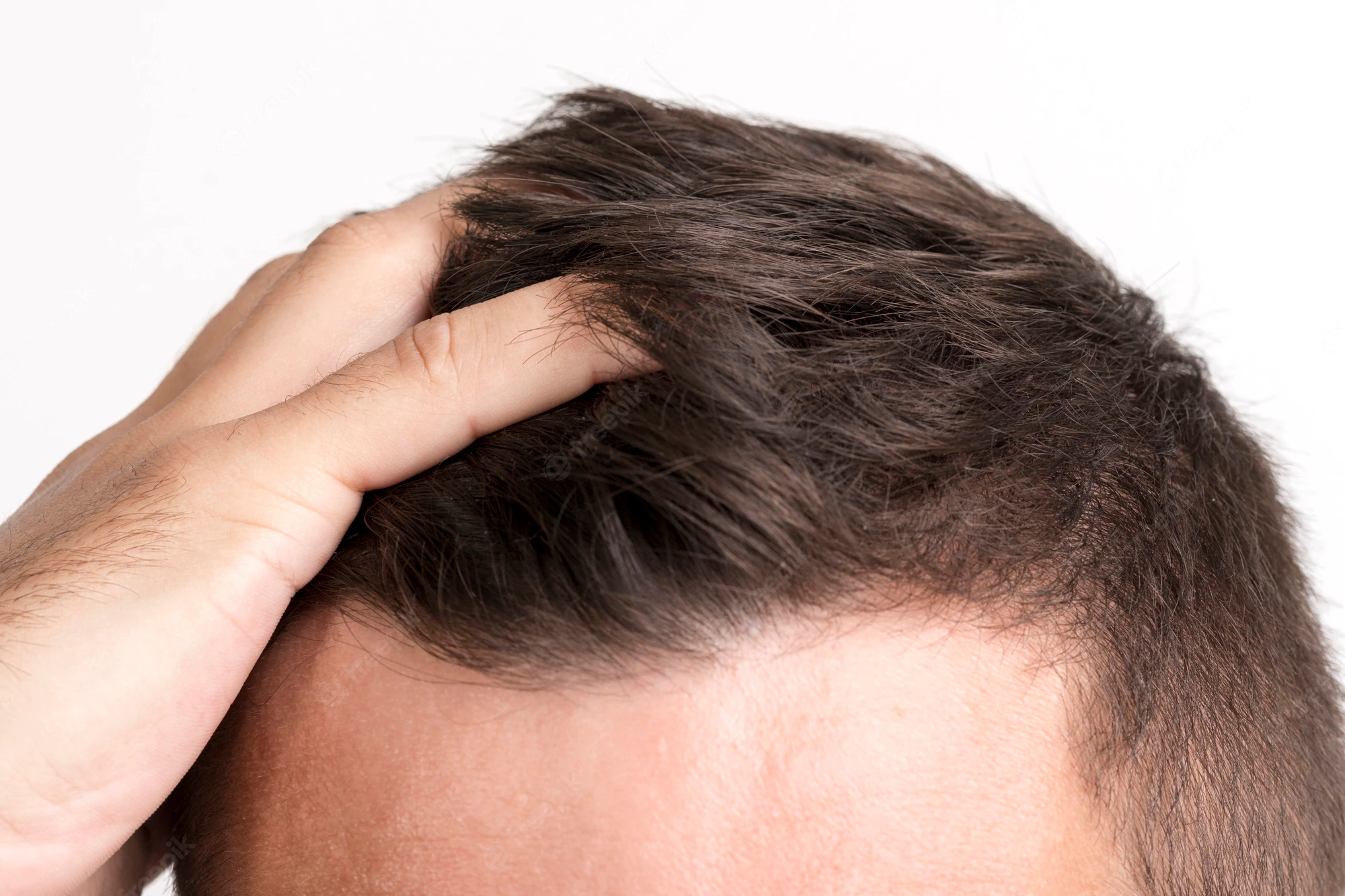 switching from finasteride to dutasteride for hair loss