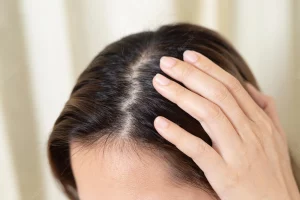 dandruff can be caused by dry skin medical conditions such as psoriasis 479128 468