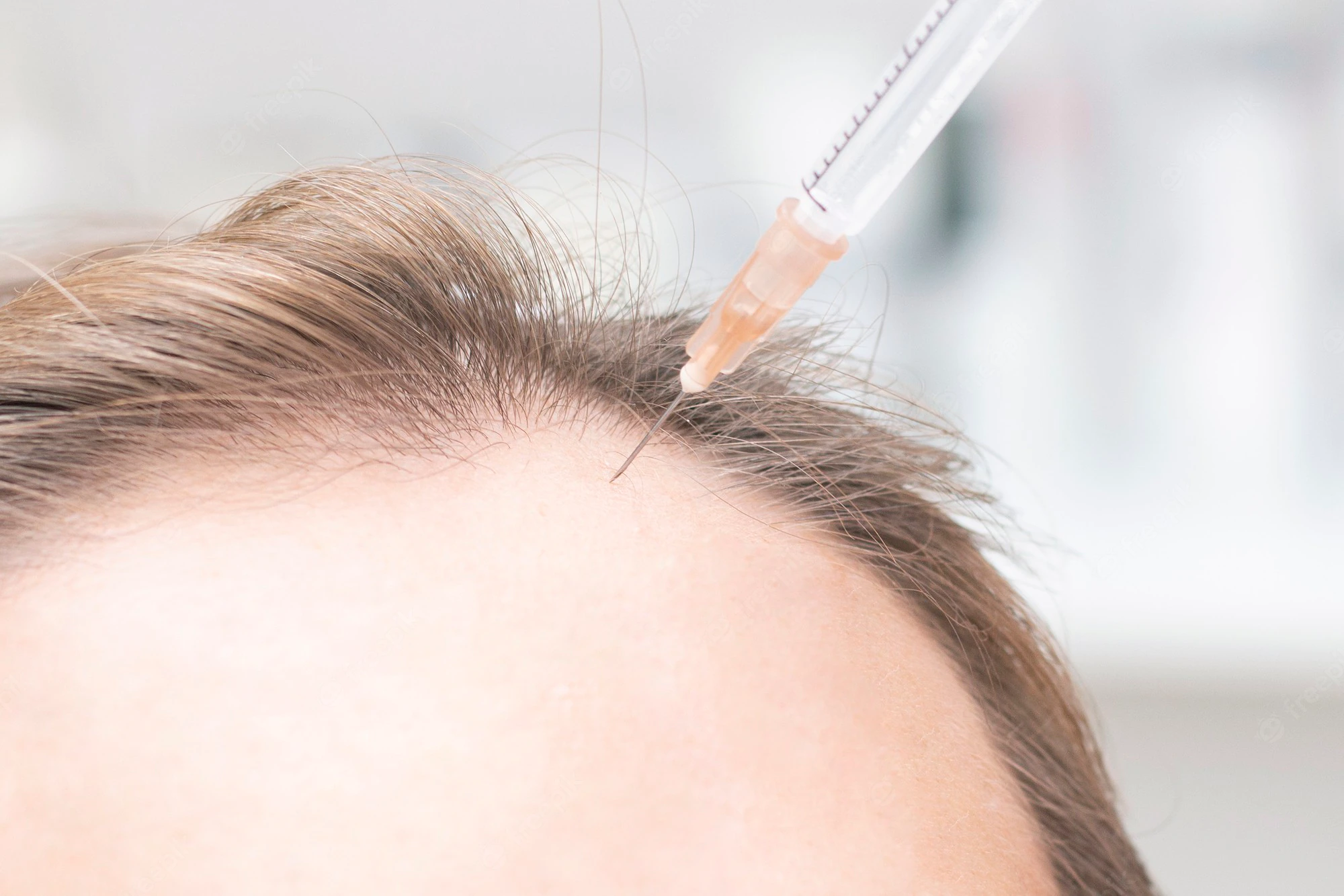 does dianabol cause hair loss