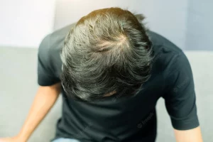 does perm cause hair loss male