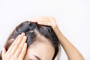 young asian women worried about hair loss problems 44943 1403