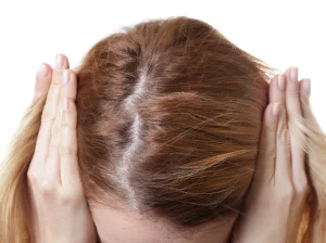 benzoyl peroxide and hair loss